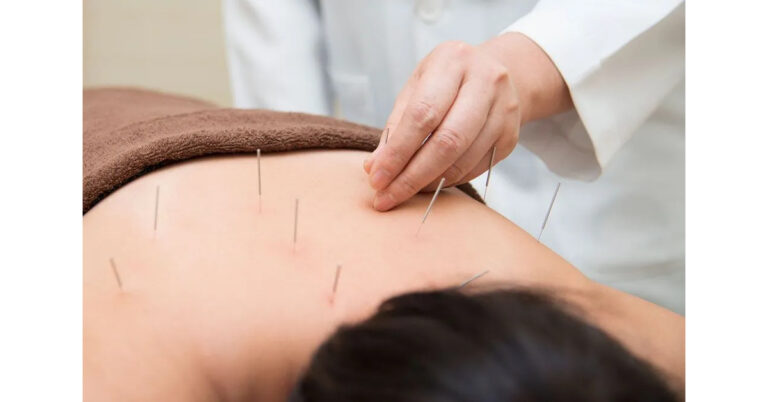 Discover the Benefits of TCM Acupuncture in Singapore: A Comprehensive Guide